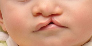 Заячья губа: причины появления