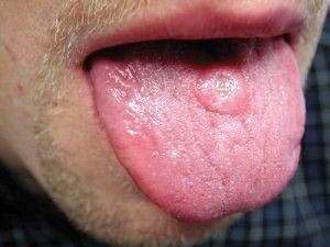 Sifilis-afta-oral