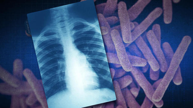лечение туберкулеза легких в домашних условиях