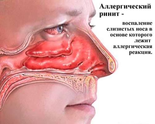профилактика заболеваний носа