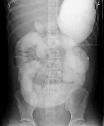 Рентген желудка с барием что показывает