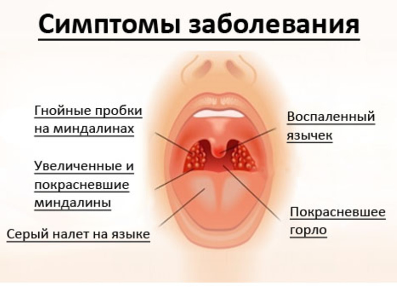 Симптомы заболевания