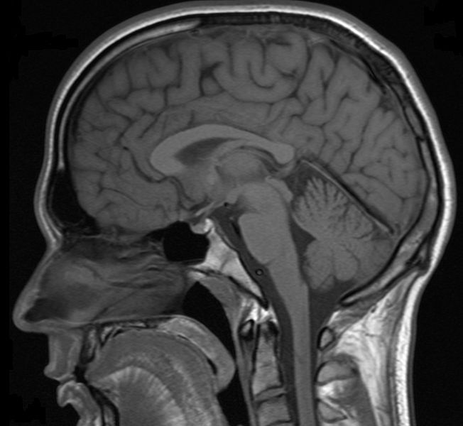 расширение субарахноидальных пространств головного мозга у взрослых
