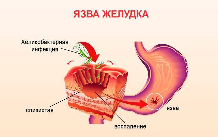 Síntomas del helicobacter