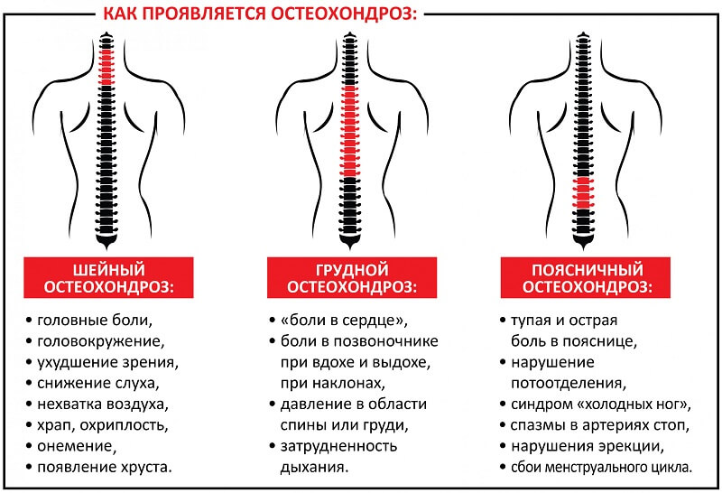 Остеохондроз при парестезии