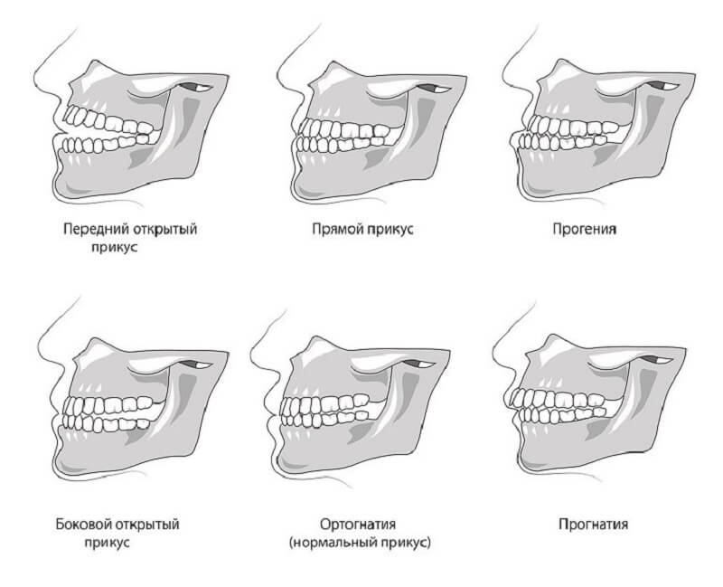 Виды прикуса