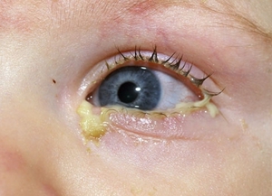 Как промывать глаза ребенку