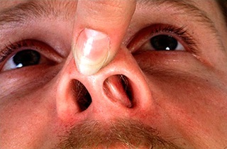 Последствия болячек в носу