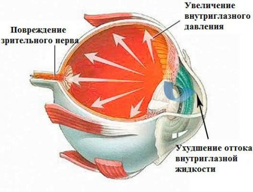 Повреждающие факторы при глаукоме