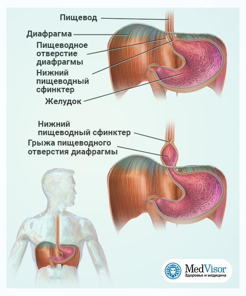 Каша при диафрагмальной грыже