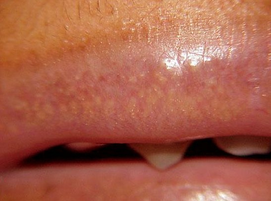 white spots on lips pictures 2