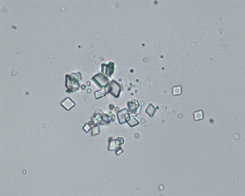 Песок в осадке мочи. Струвиты и оксалаты под микроскопом. Струвиты микроскопия. Струвиты оксалаты трипельфосфаты.