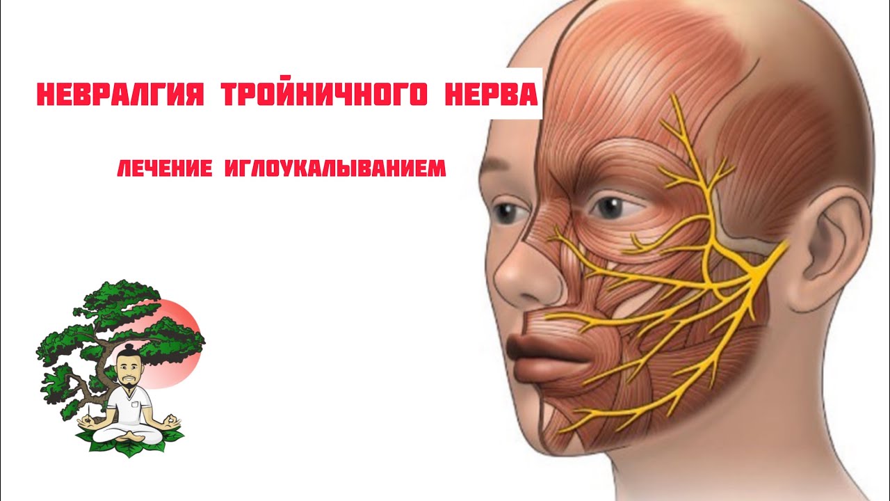 Иглоукалывание лицевой нерв. Воспаление троичногонерва. Воспаление тройничного нерва. Воспаление тройничного нерва на лице.