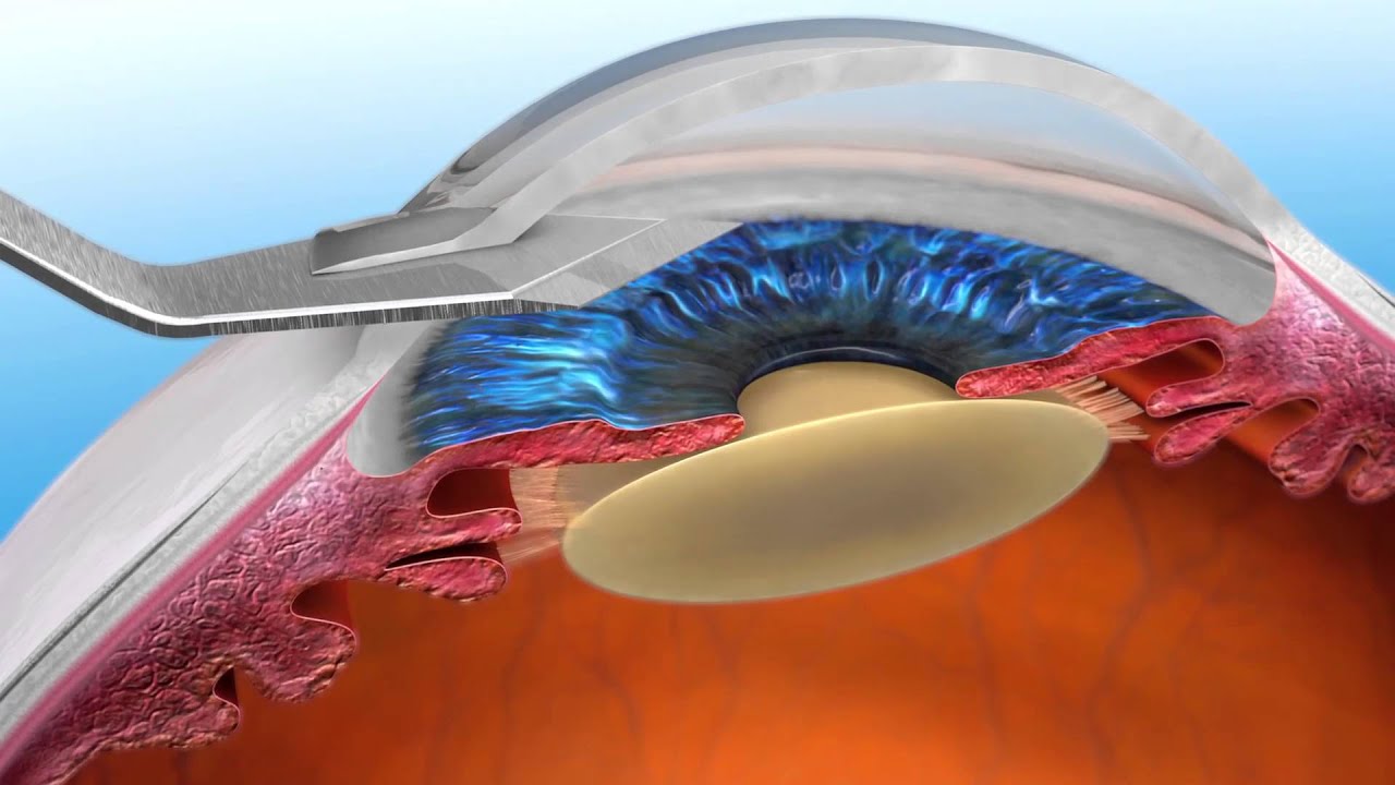 Глаз после замены хрусталика фото