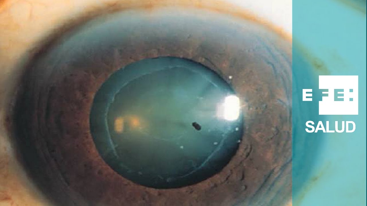 Баня после катаракты. Псевдоэксфолиативная открытоугольная глаукома. Открытоугольная глаукома глаз. Кольцевидная катаракта Фоссиуса. Зрачковый блок глаукома.