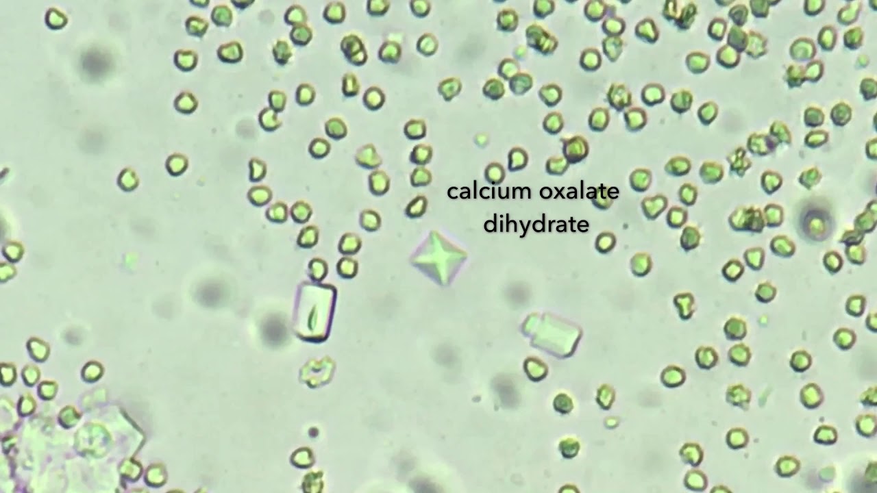 Оксалаты кальция в моче. Кристаллы моногидрата оксалата кальция. Оксалты кальция моногидрат. Моногидрат кальция в моче. Моногидрат оксалата кальция под микроскопом.