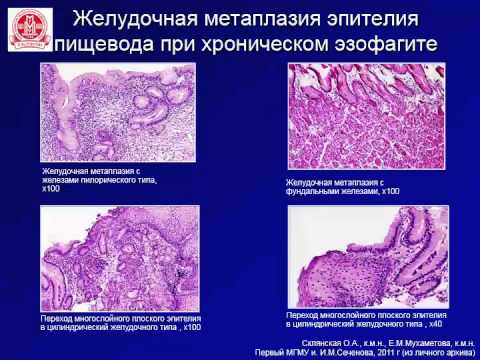 Цилиндроклеточная метаплазия пищевода