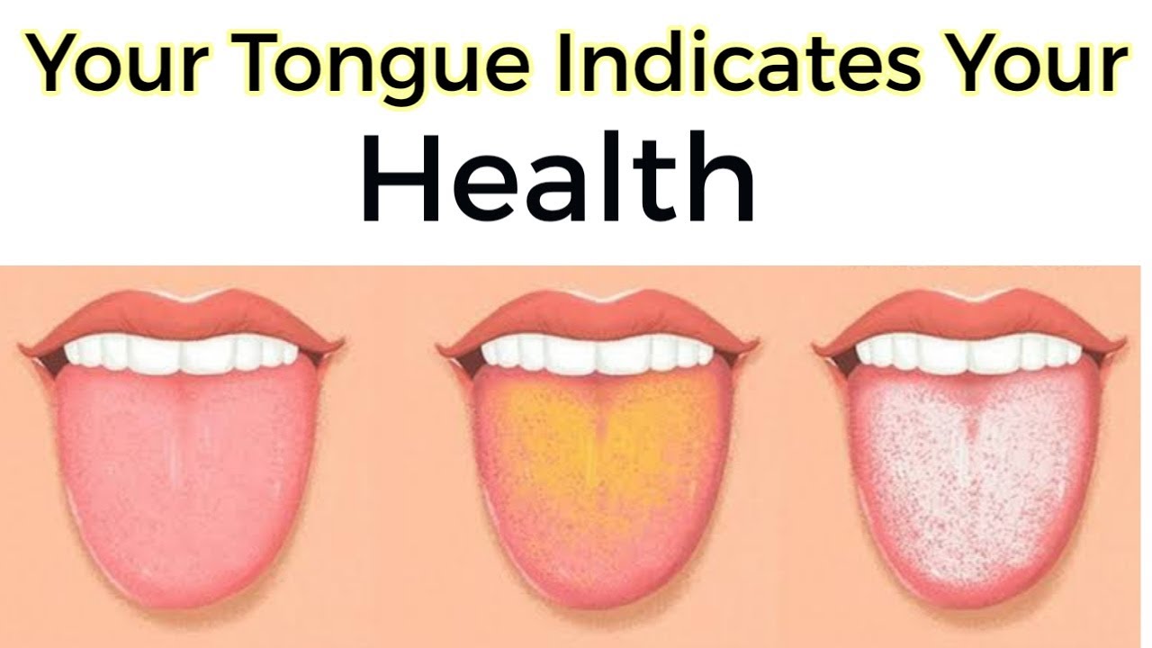 Язык человека определить болезнь. Заболевания по цвету языка. Желтый налет на языке у человека.