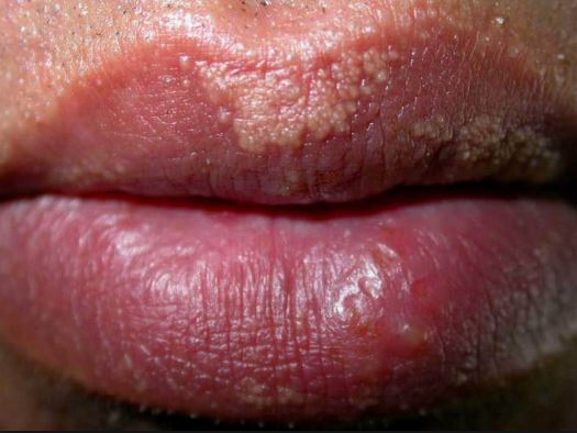 Clusters of small white bumps on lips