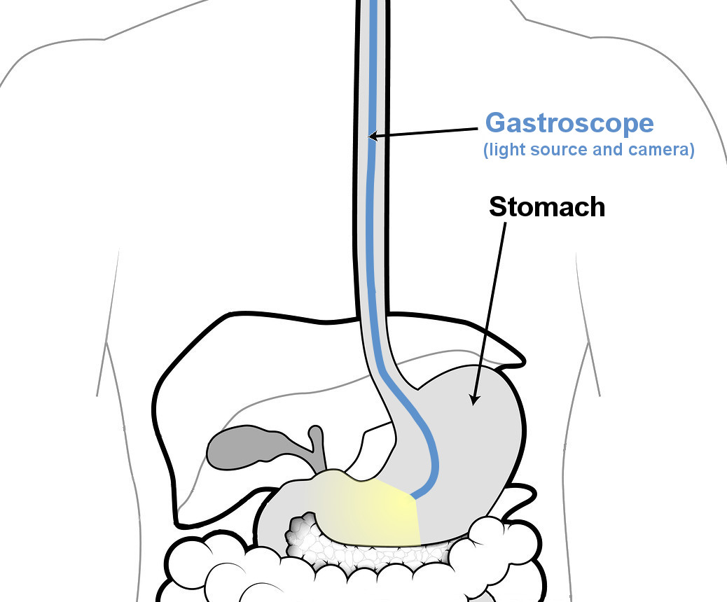 Зондирование желудка