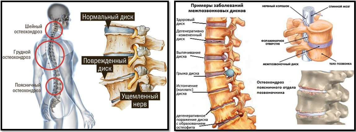 Степени остеохондроза позвоночника. Остеохондроз шейного отдела грыжа межпозвоночного диска. Остеохондроз протрузия грыжа. Остеохондроз поясничного отдела схема. Остеохондроз шейного отдела протрузии дисков.