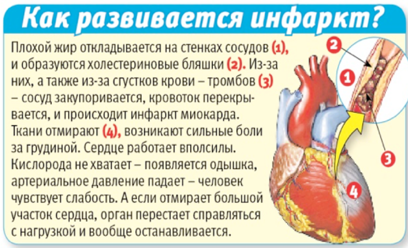 Жизнь после инфаркта. Стенд для сердца при инфаркте миокарда. Инфаркт миокарда чаще развивается в. Инфаркт сердца развивается в как.