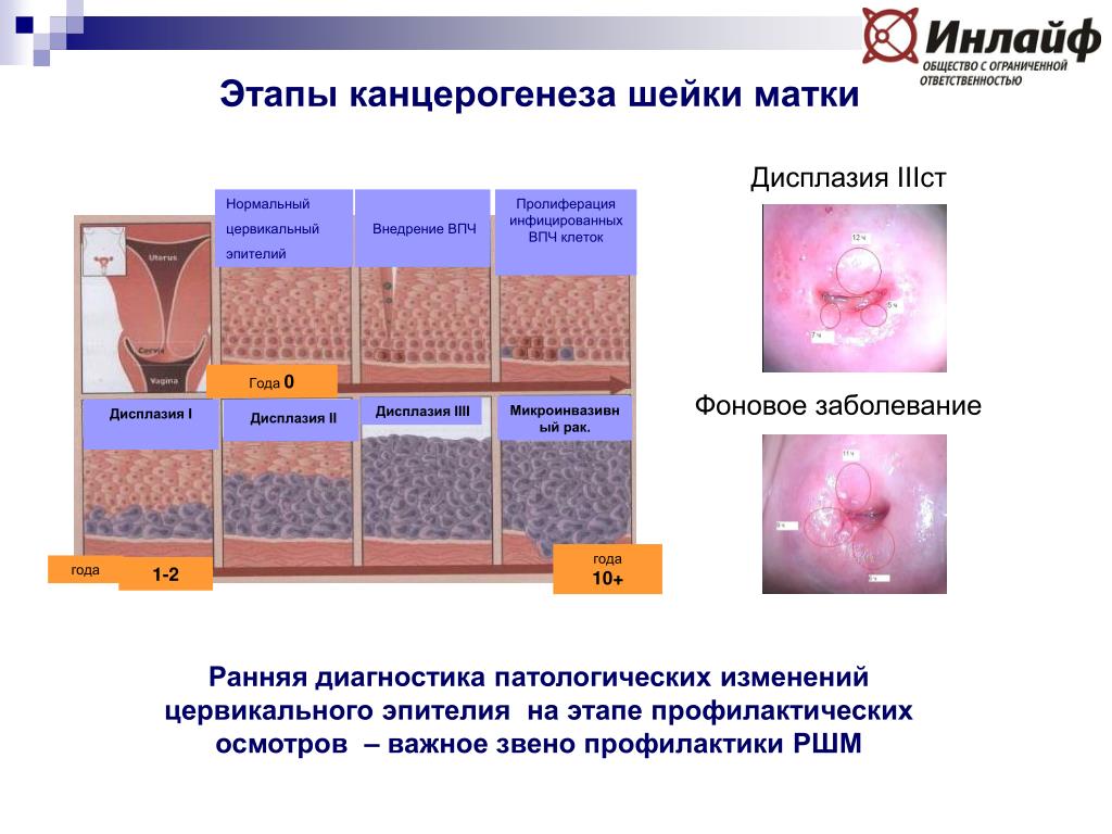 Дисплазия шейки матки презентация