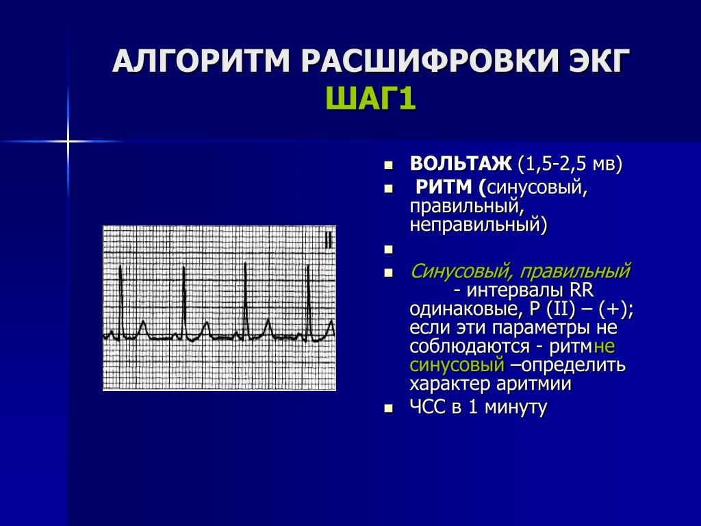 Экг. ЭКГ расшифровка Вольтаж. ЭКГ P(MS) 105. Кардиограмма сердца расшифровка синусовый ритм норма у взрослых. Порядок расшифровки ЭКГ алгоритм.