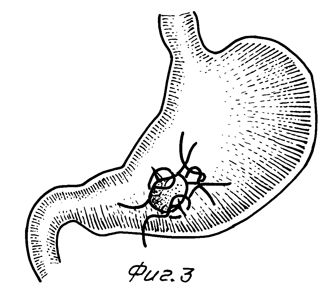 Перфорация желудка. Ушивание перфоративной язвы желудка. Ушивание язвы желудка и 12-перстной кишки. Ушивание перфоративной язвы ДПК. Перфоративная язва желудка ушивание.