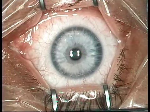 Видео Как делают лазерную коррекцию зрения