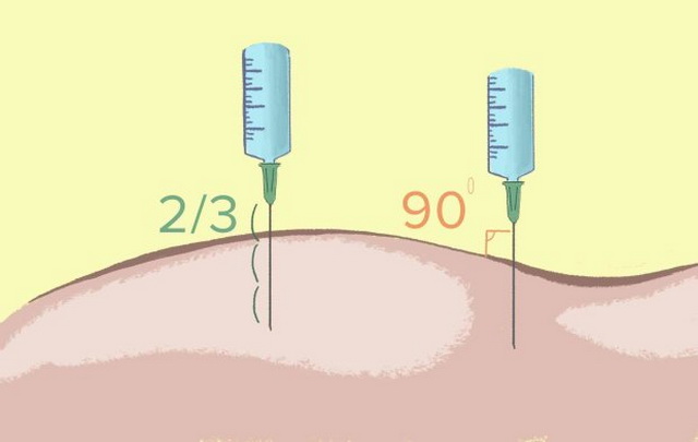 Схема постановки укола в ягодицу