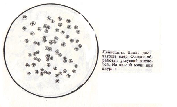 Эритроциты в моче картинки