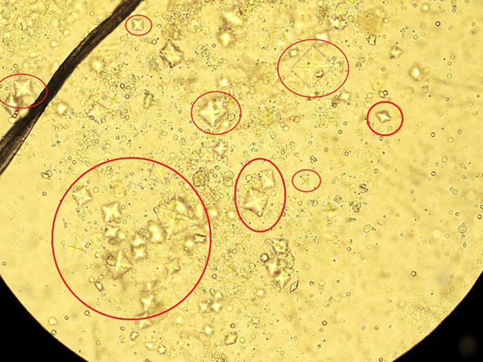 Кристаллы оксалата в моче у мужчин. Оксалаты микроскопия мочи. Микроскопия осадка мочи оксалаты. Оксалаты кальция в моче. Оксалаты кальция в моче микроскопия.