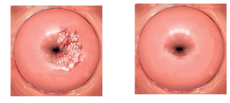 Цервицит и нормальная шейка матки
