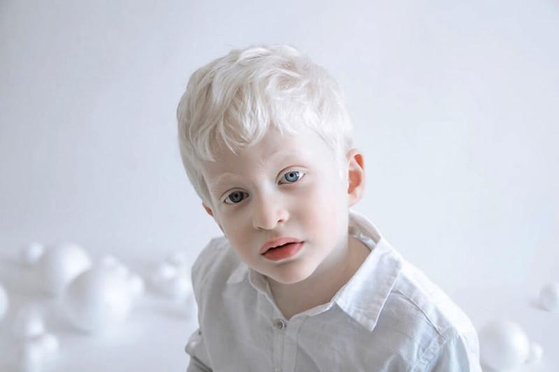 Ребёнок альбинос