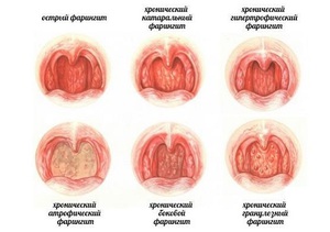 Формы фарингита