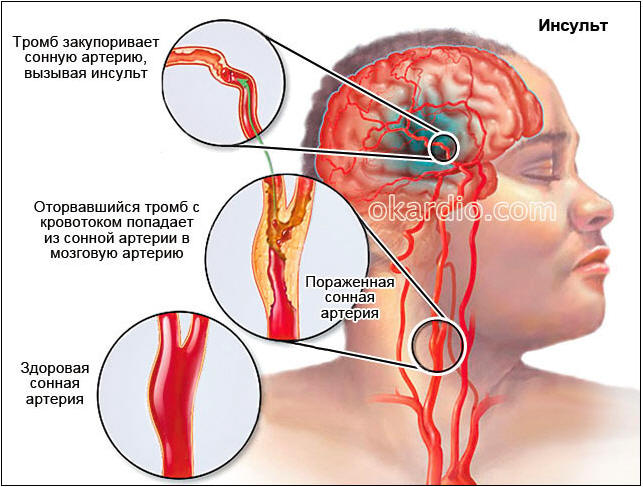 Тромбозы сосудов головного. Микро ишемический инсульт. Тромбоз сонной артерии.