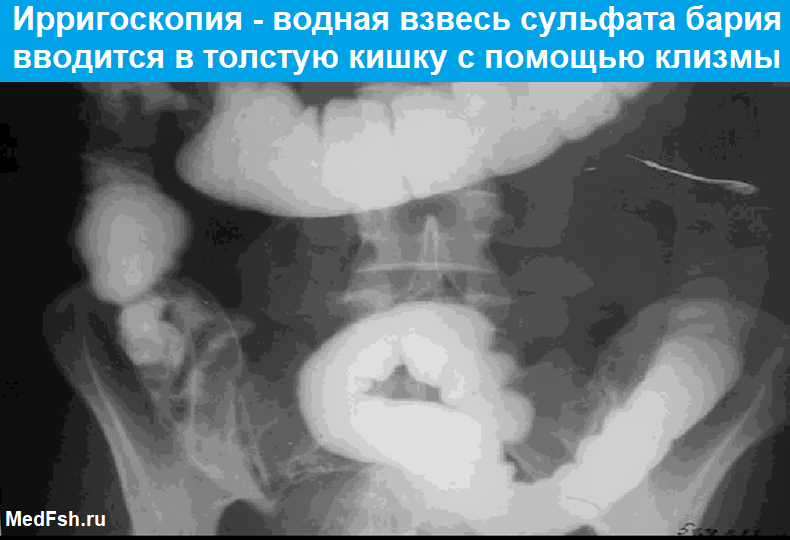 Ирригоскопия при хроническом гастрите подготовка. Ирригоскопия с сульфатом бария. Рентген кишечника с барием полипы. Последовательность ирригоскопии.