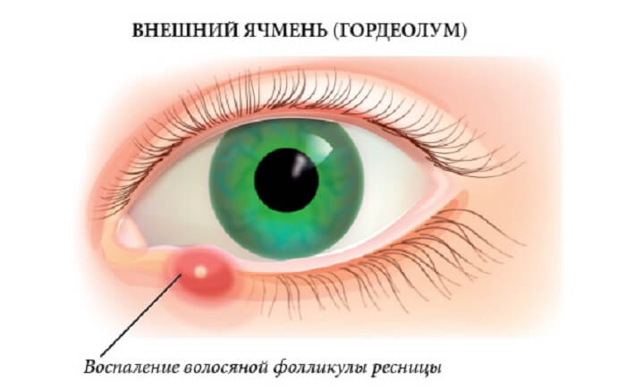 Воспаление фолликулы глаза