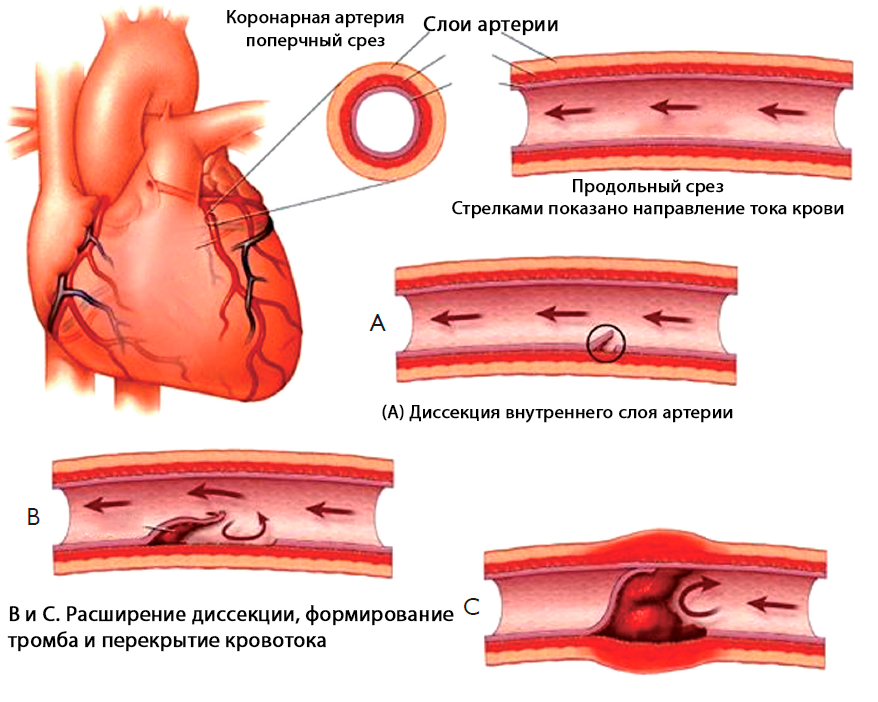 Коронарная смерть причины у мужчин. Осложнения стентирования коронарных артерий сердца. Инфаркт миокарда стентирование осложнения. ИБС атеросклероз коронарных артерий. Стентирование коронарных сосудов осложнения.