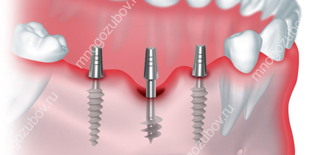 Что такое одномоментная имплантация зубов
