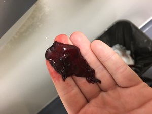 кусок крови похожий на печень во время менструации 