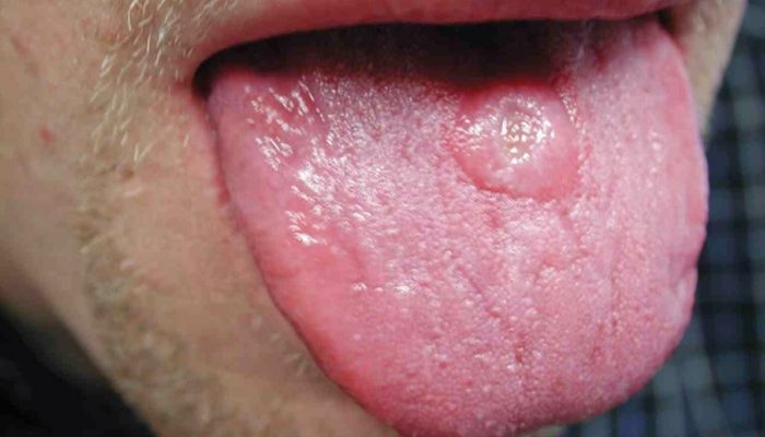 Какая бывает сыпь при сифилисе? Первые симптомы и проявления на коже, характерные высыпания при вторичной форме, а также отличие от обычных прыщей и тактика лечения