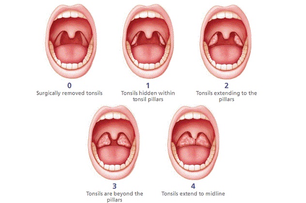 Осложнения при заболеваниях в горле