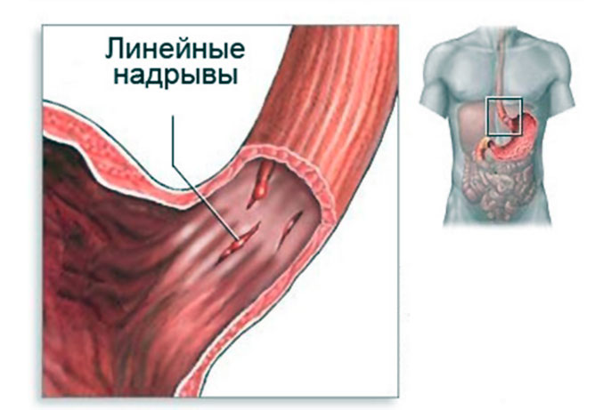 Желудок рефлюкс эзофагит