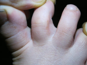 Сыпь между пальцами ног