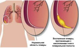 Болит нижнее ребро слева при нажатии