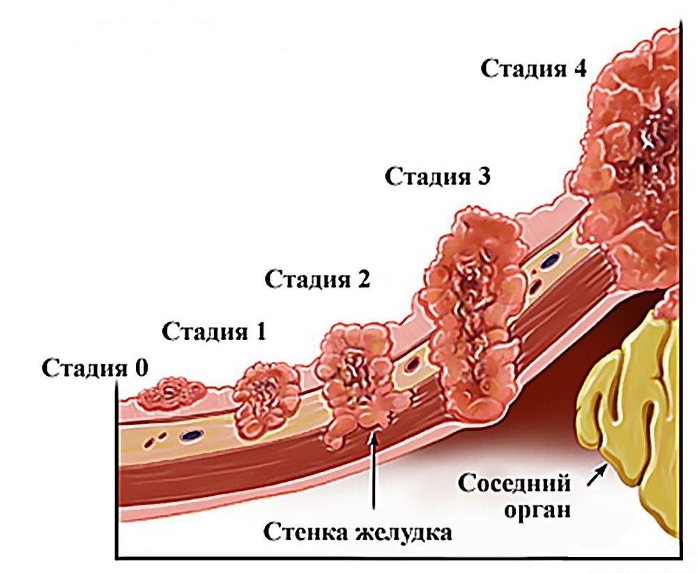 Код рака желудка в МКБ 10 – C16, подгруппы и описание внутри