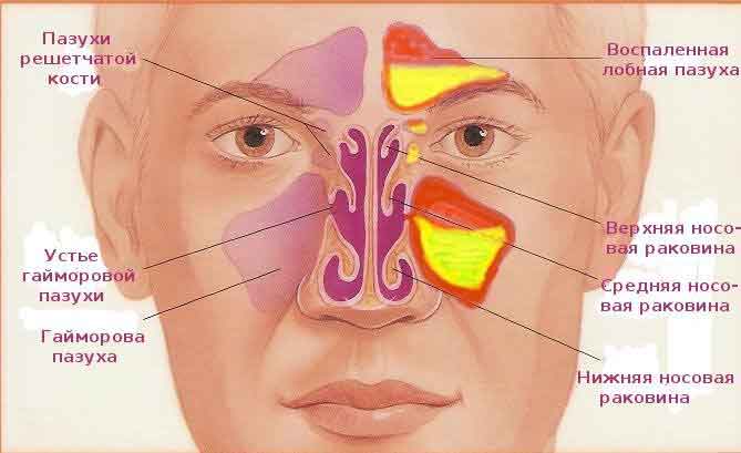 Фурацилин при гайморите: промывание носа раствором