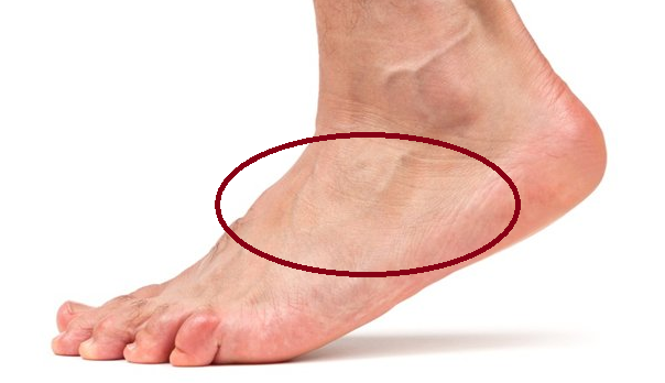 Причины боли внутренней стороны стопы. Гигрома голеностопного сустава.